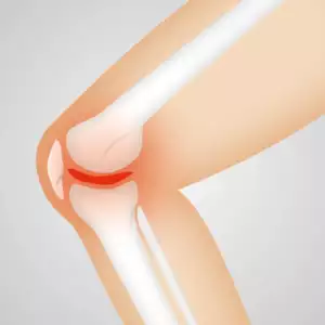 causes de la douleur derrière le genou