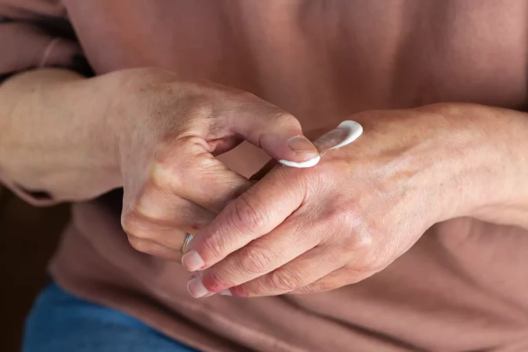 Quelle est la meilleure pommade pour l’arthrose ? (2023)