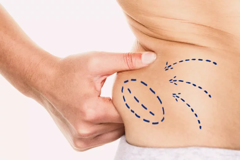 Liposuccion pour homme : Tout savoir (2023)