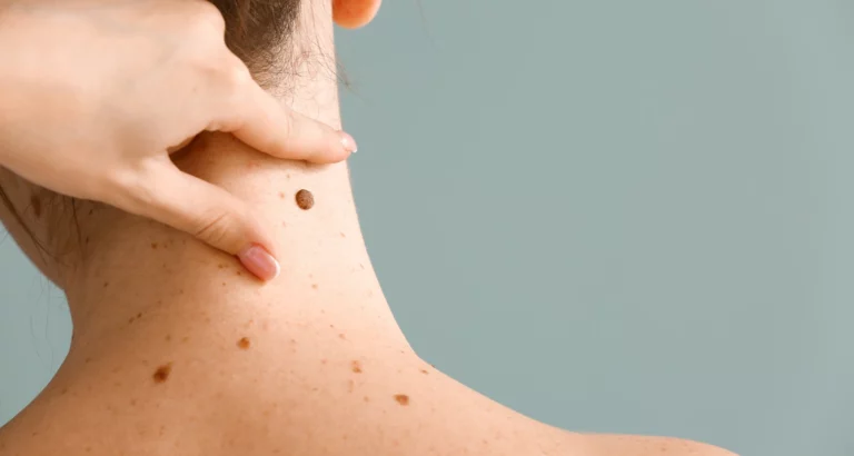 Enlever un grain de beauté : A savoir avant de vous lancer